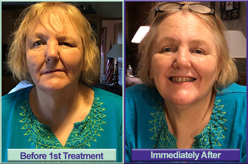 Before & After Treatment Before & After Treatment